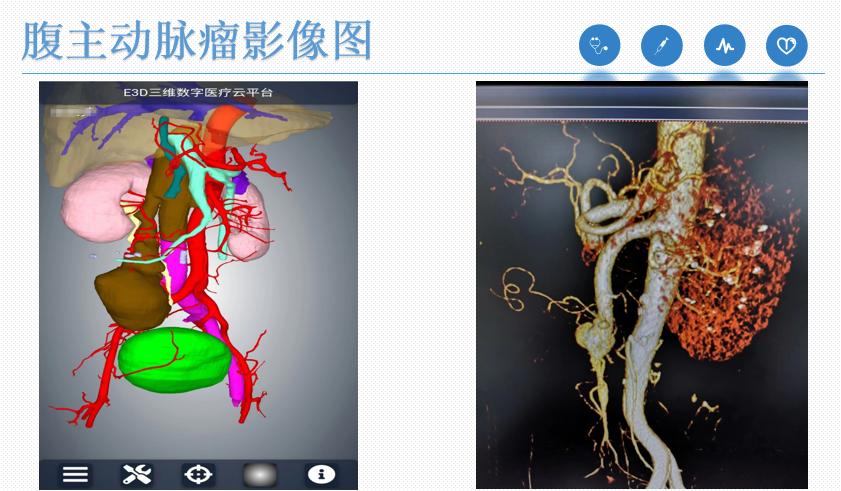 腹主动脉瘤彩超01