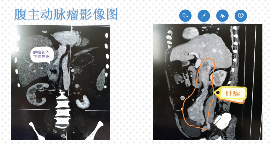 腹主动脉瘤彩超