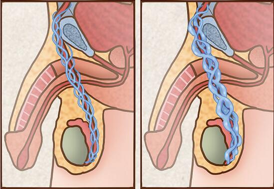 精索静脉曲张