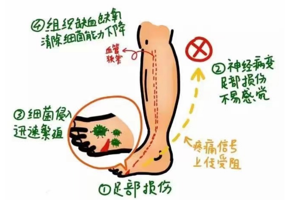 糖尿病足